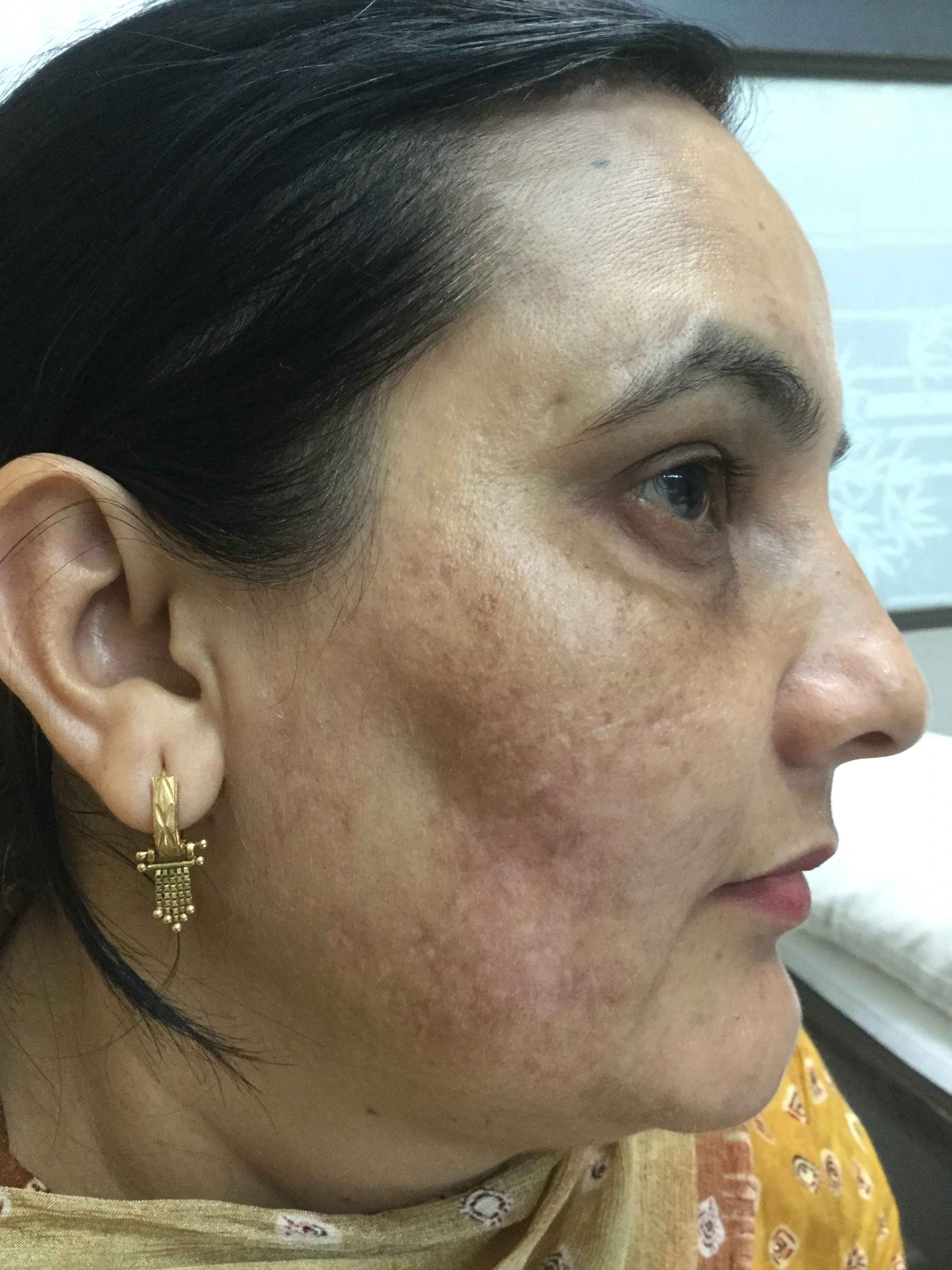 Acne after, Client 1