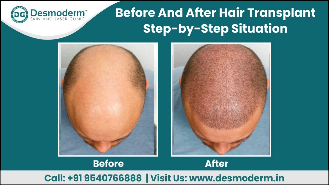 Before and after hair transplant StepbyStep Situation Desmoderm