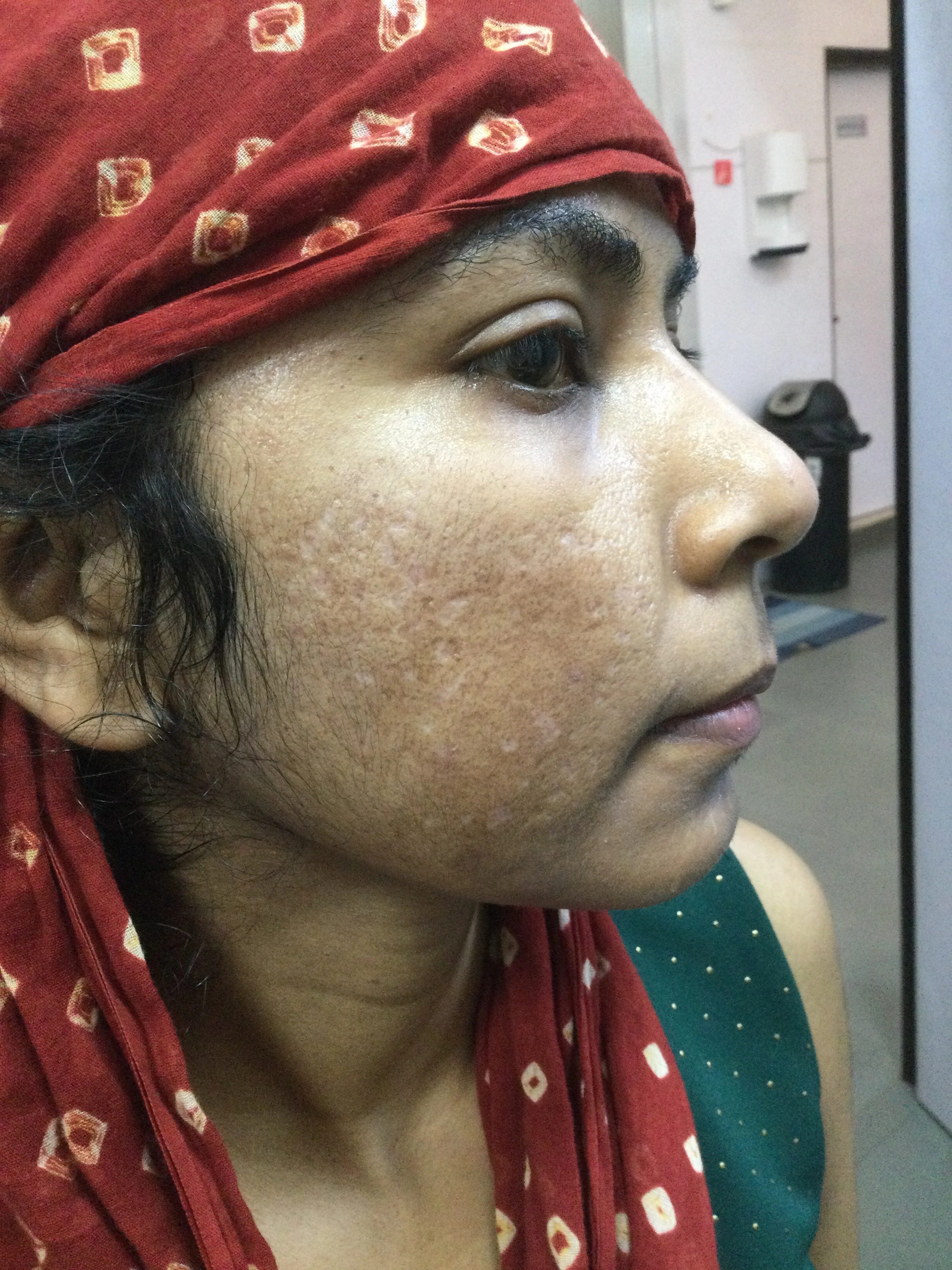 Co2 Fractional after, Client 1