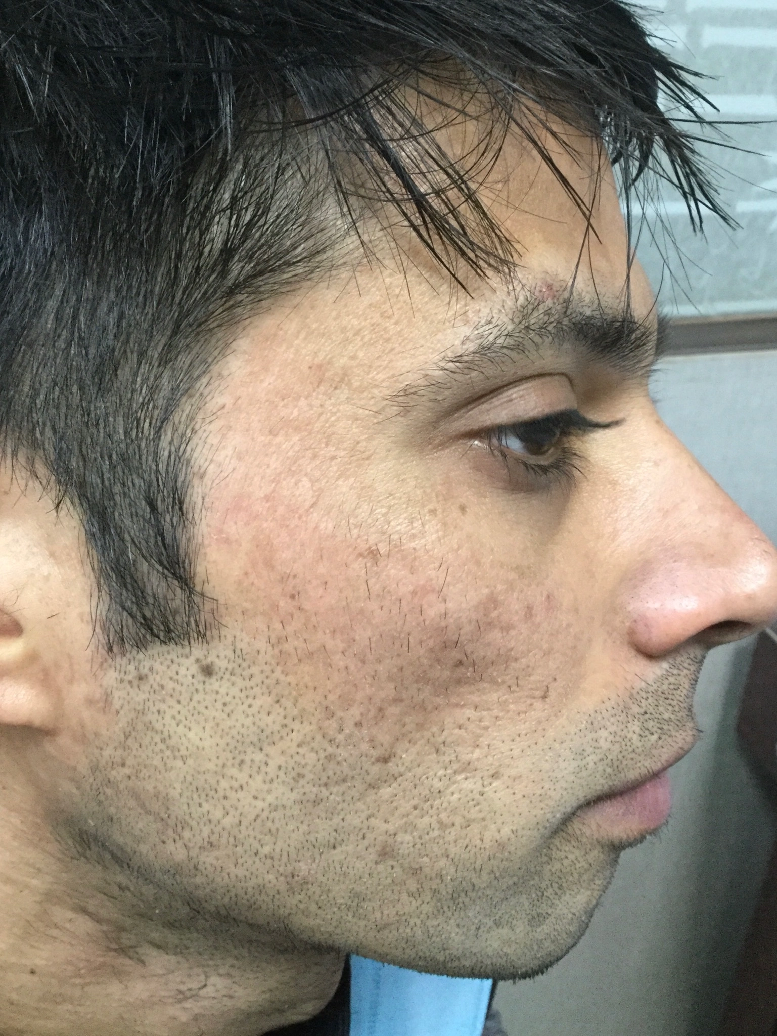 Co2 Fractional after, Client 2