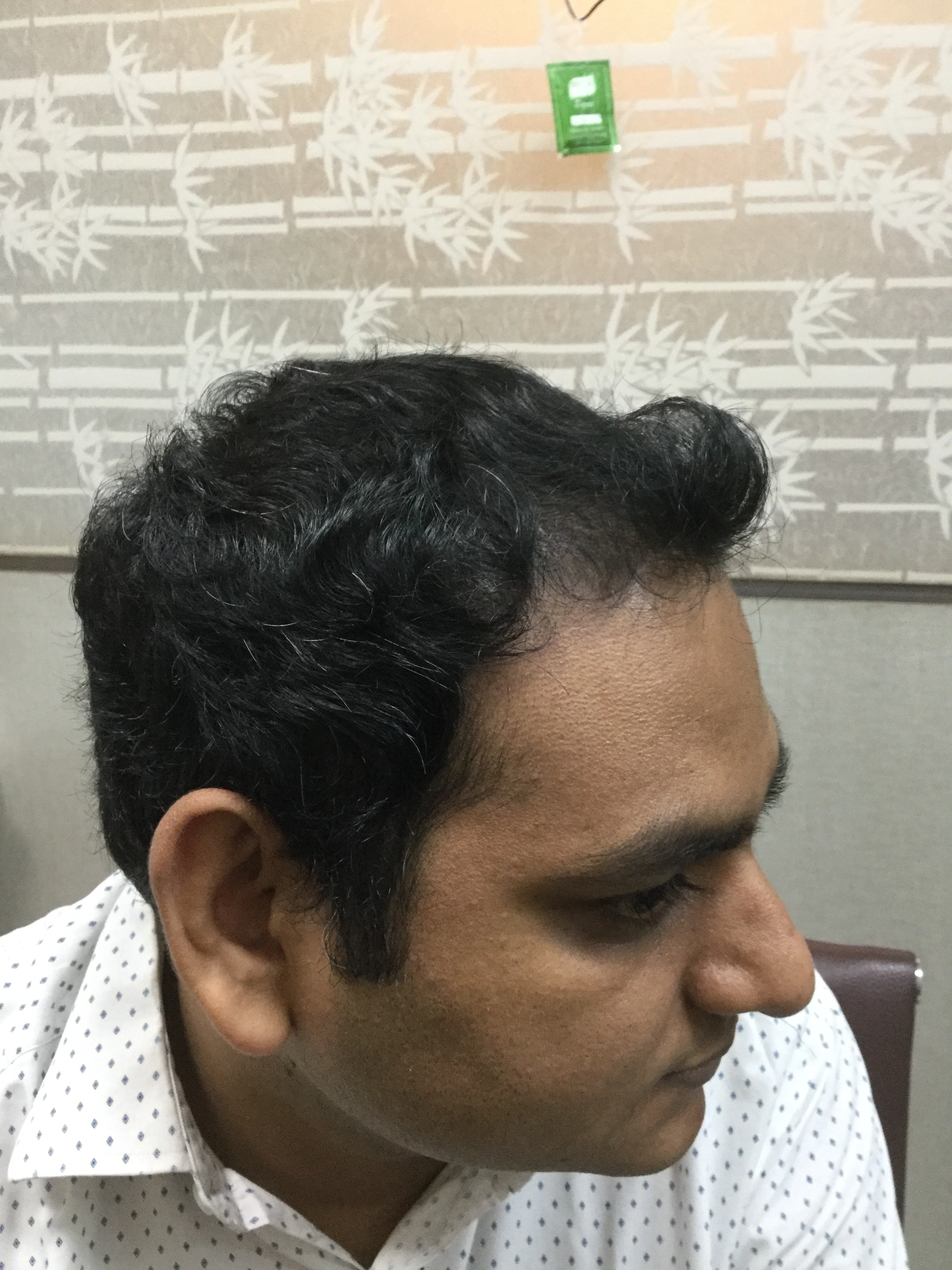 Hair PRP after, Client 3