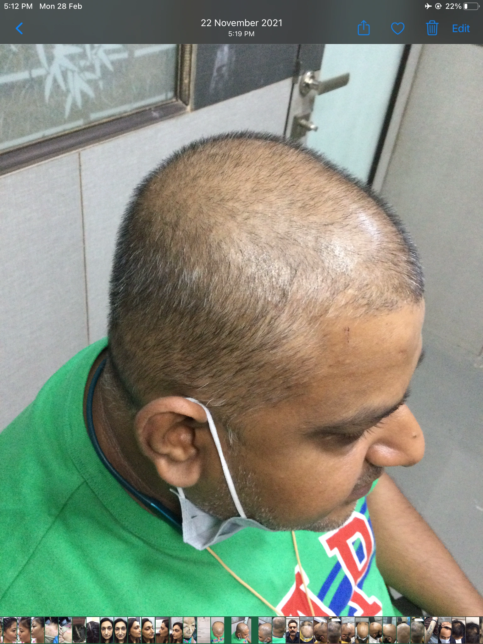Hair PRP before, Client 2